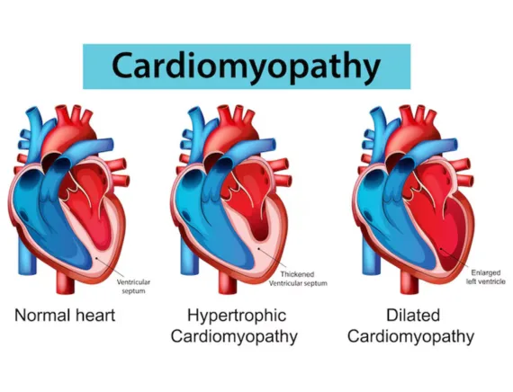 Cardiomyopathy treatment in Gorakhpur