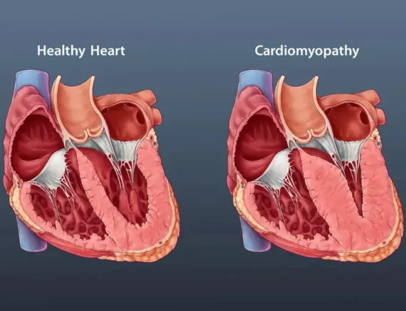 Cardiomyopathy treatment in Gorakhpur