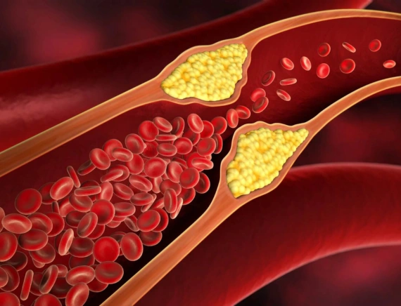 Cholesterol Treatment in Gorakhpur 