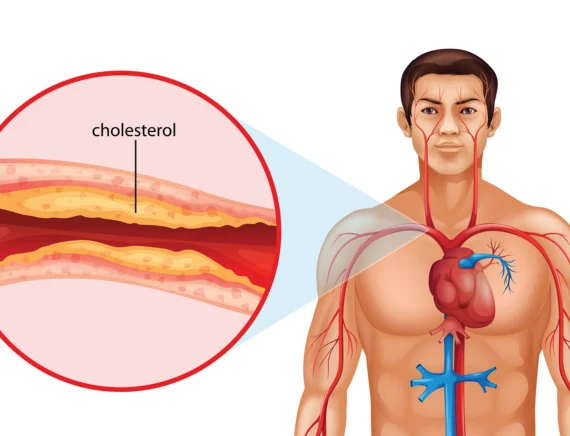 Cholesterol Treatment in Gorakhpur 