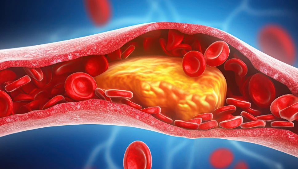 Cholesterol Treatment in Gorakhpur 