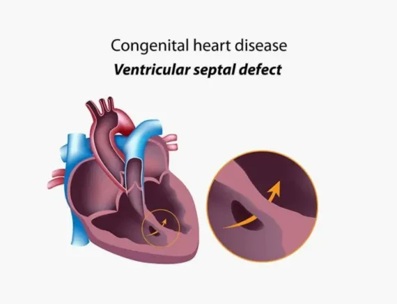 Congenital Heart Disease in Gorakhpur