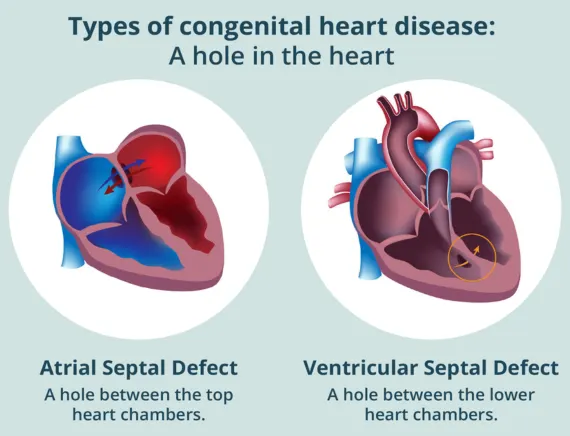 Congenital Heart Disease in Gorakhpur