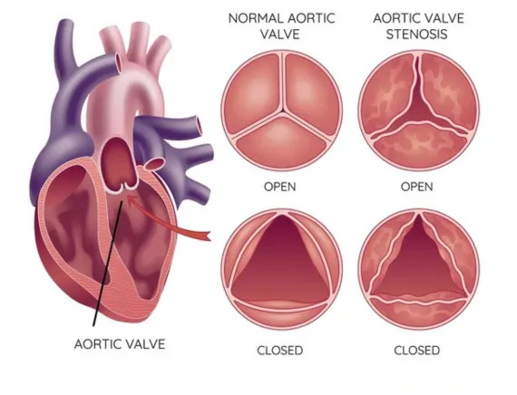 Heart valve problems treatment in Gorakhpur