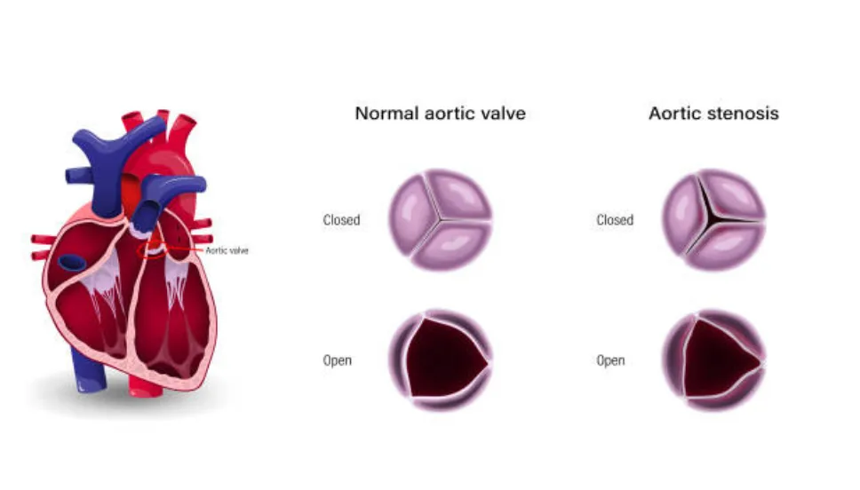 Heart valve problems treatment in Gorakhpur