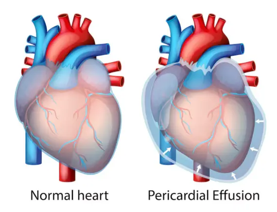 Pericardial Disease Treatment in Gorakhpur