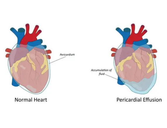Pericardial Disease Treatment in Gorakhpur