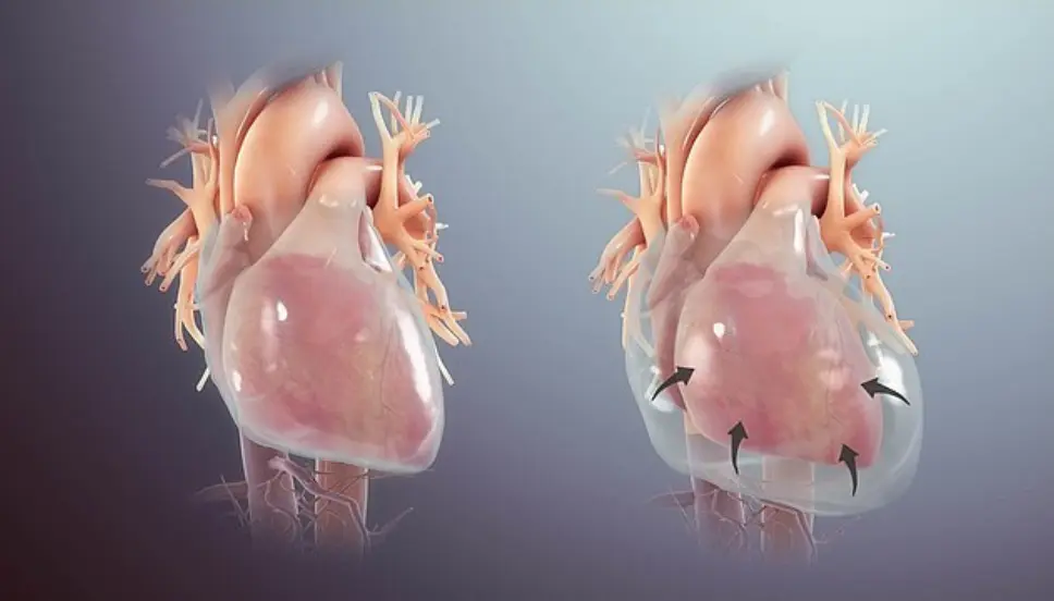 Pericardial Disease Treatment in Gorakhpur